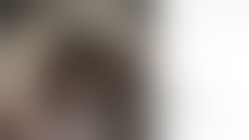 FTRD® System | Hybrid FTRD of rectal adenoma