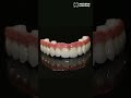 All-on-X | Direct-to-MUA (Multi-Unit Abutments)