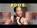 Dark Neck, Armpits? How to Treat and Prevent Acanthosis Nigricans | PCOS
