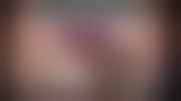 CataractCoach™ 1934: combined IOL and iris prosthesis for aphakia and aniridia