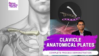 Clavicle Anatomical Plates Fixation Procedure