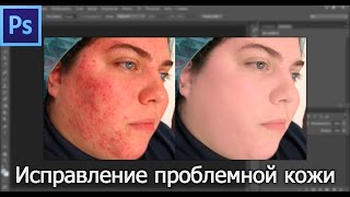 Как убрать прыщи в фотошопе Как убрать прыщи в фотошопе