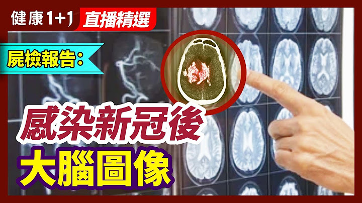 即使是轻微的新冠感染，也会使大脑产生惊人变化？ | 健康1+1 · 直播 - 天天要闻