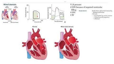 USMLE Pressure Volume Loops Questions and Basics