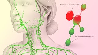 Как в домашних условиях убрать ВОСПАЛЕНИЕ лимфатических УЗЛОВ. Эффективные средства лечения