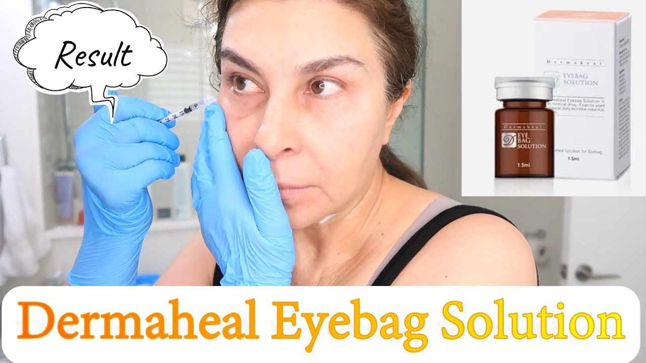DermaHeal Eyebag Solution Before and After | Avoid my Mistake | PDO ...