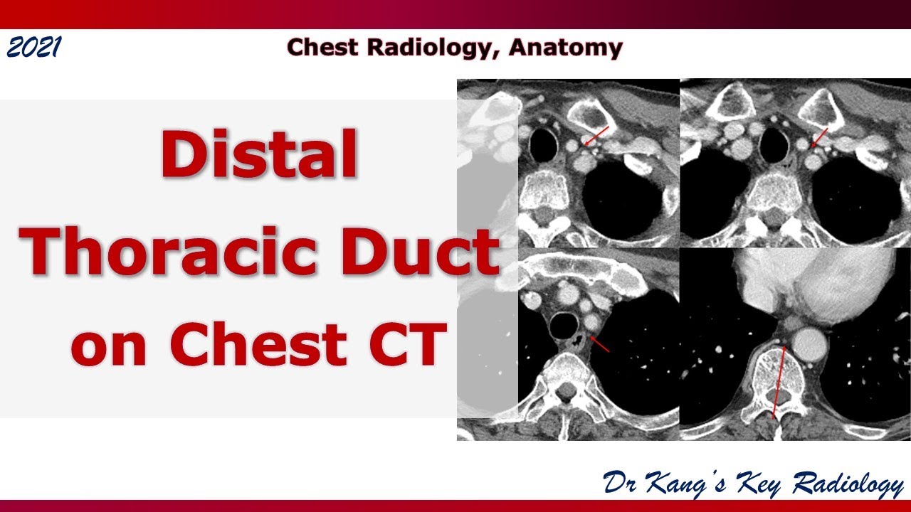 Distal Thoracic Duct Ct Anatomy Youtube