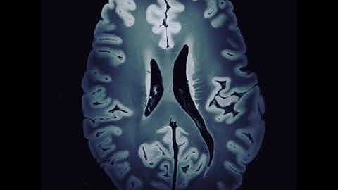 7 Tesla MRI - The Highest Resolution Image of the Brain in the World