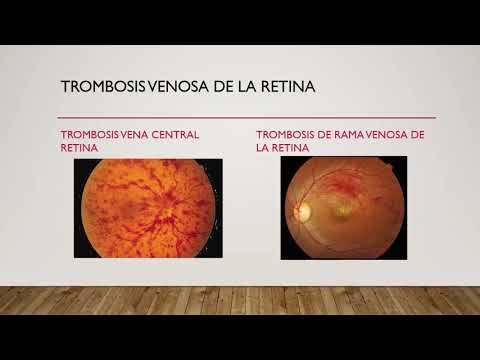 Vídeo: Trombosis De Retina