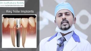 Best Dental Implant Surgeon in Bangalore | Tooth Replacement India