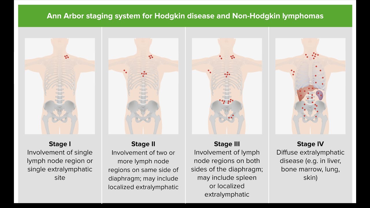 Treating Classic Hodgkin Lymphoma by Stage - YouTube