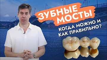 Зубной мост. Мостовидный протез.