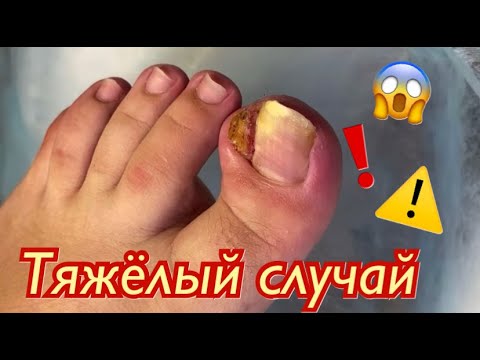 Тяжёлый случай😱❗️⚠️🆘🦶🏻