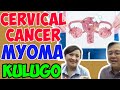 Cervical Cancer, Myoma, Genital Warts o Kulugo sa Ari - by Doc Willie Ong #189