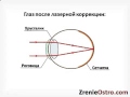 Делать или нет лазерную коррекцию зрения? Секрет раскрыт!