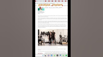 Man with paralysis walks naturally after brain, spine implants