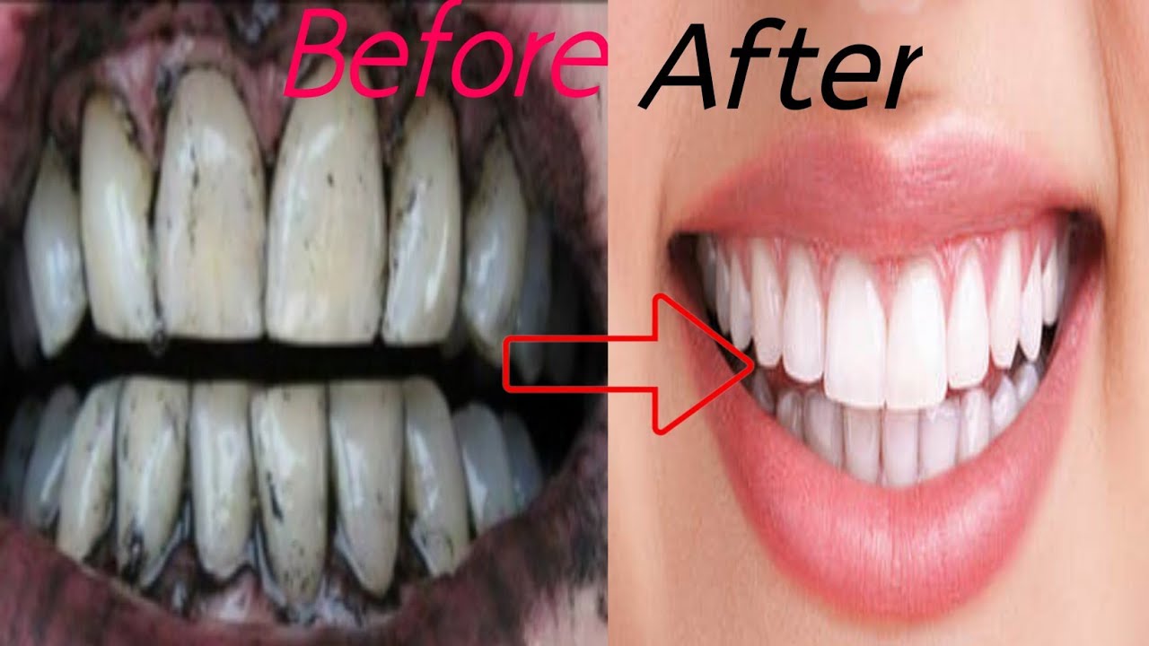 how-to-remove-black-stains-on-teeth-at-home-youtube