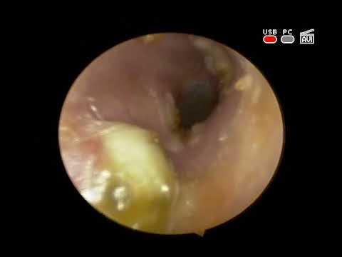 Лечение фурункула уха (терапия)