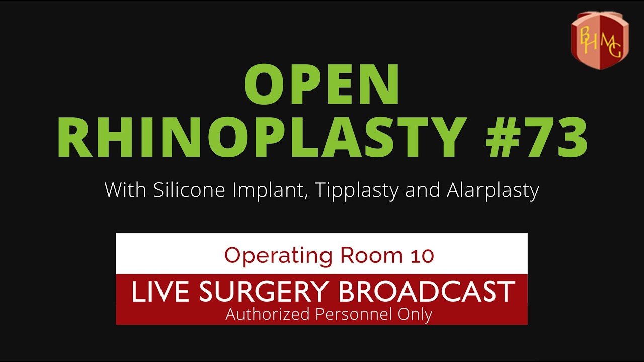 Open Rhinoplasty With Silicone Implants, Tipplasty and Alarplasty Surgery #73 – How Its Done. Open Rhinoplasty With Silicone Implants, Tipplasty and Alarplasty Surgery #73 – How Its Done.