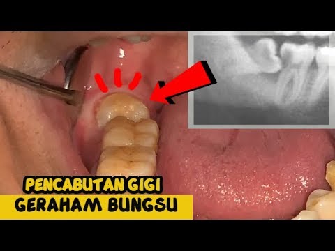 Video: Apakah menyakitkan untuk mencabut gigi bungsu?