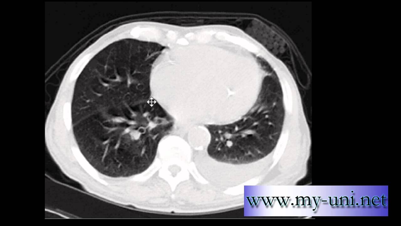 CT Scan Chest How To Tell If A Patient Is A Smoker YouTube ct-scan-chest-how-to-tell-if-a-patient-is-a-smoker-youtube