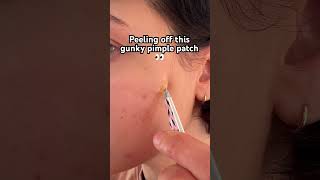 😍 Look at this pimple patch peel🙌 #pimplesolution #pimplepatch #acne #acneproneskin