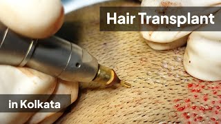 FUE হেয়ার ট্রান্সপ্লান্ট কলকাতা | Best Hair Transplantation Clinic in Kolkata | Dr Jayanta Bain