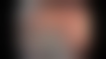 Colonoscopy: Ascending Colon LST-G tumor EMR+APC+Clips