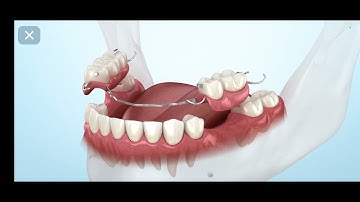 RPD (removal partial denture) with clasps
