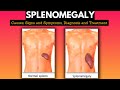 Splenomegaly, Causes, Signs and Symptoms, Diagnosis and Treatment