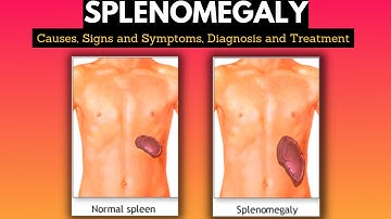 Splenomegaly, Causes, Signs and Symptoms, Diagnosis and Treatment