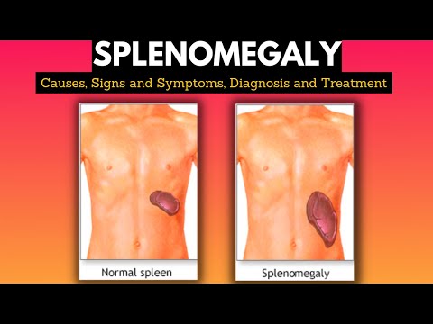 Video: Spleen - Spleen Diseases, Diagnosis, Prevention