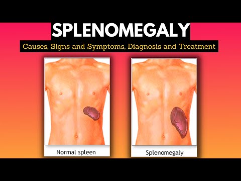 स्प्लेनोमेगाली, कारण, संकेत और लक्षण, निदान और उपचार
