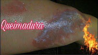 Nas uma ruim muito fico minhas com pernas queimadura