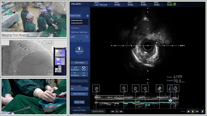 IVUS-Guided PCI DES Implantation In RCA Using ECMO And IABP Support