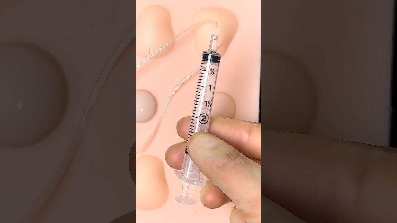 Proper Abscess Drainage: Loop Technique 