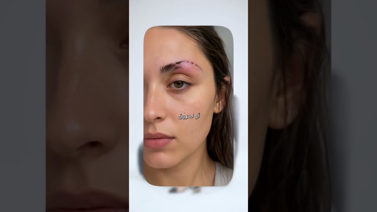Eyebrow Transplant: One Hair at a Time