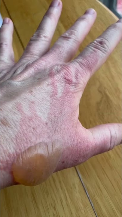 Healing Process of a Second Degree Burn
