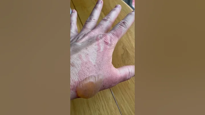 Healing Process of a Second Degree Burn