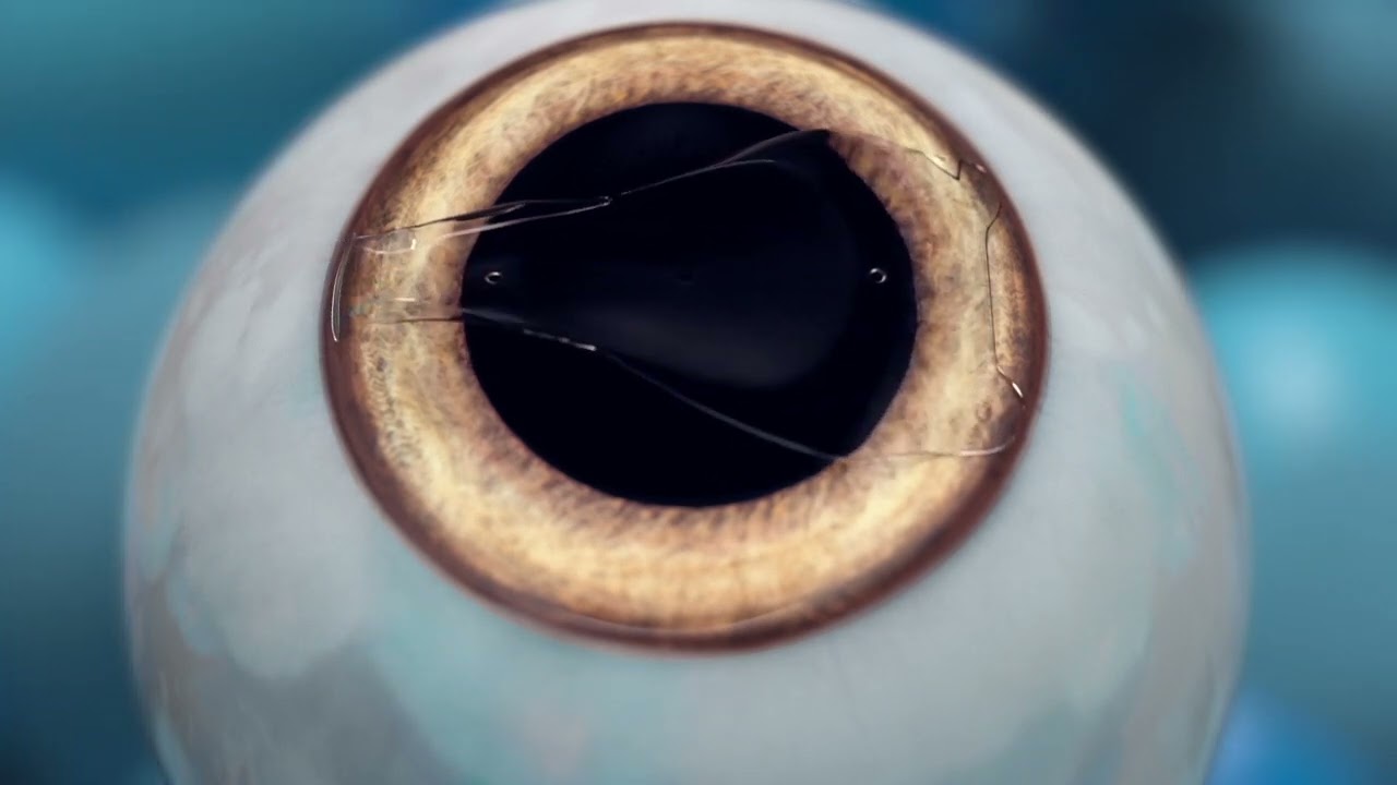 [愛瑞眼科診所] 愛瑞眼科 EVO+ICL 晶體植入術 手術過程