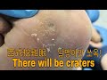 Corn removal close-up CRATER view,  굳은살+티눈제거 시원하게 다 긁어냈어요. 西式挖雞眼