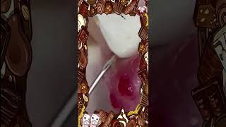 ? pimples poping from Nose full of blackheads removal Wow amazing video healthyliving newvideo