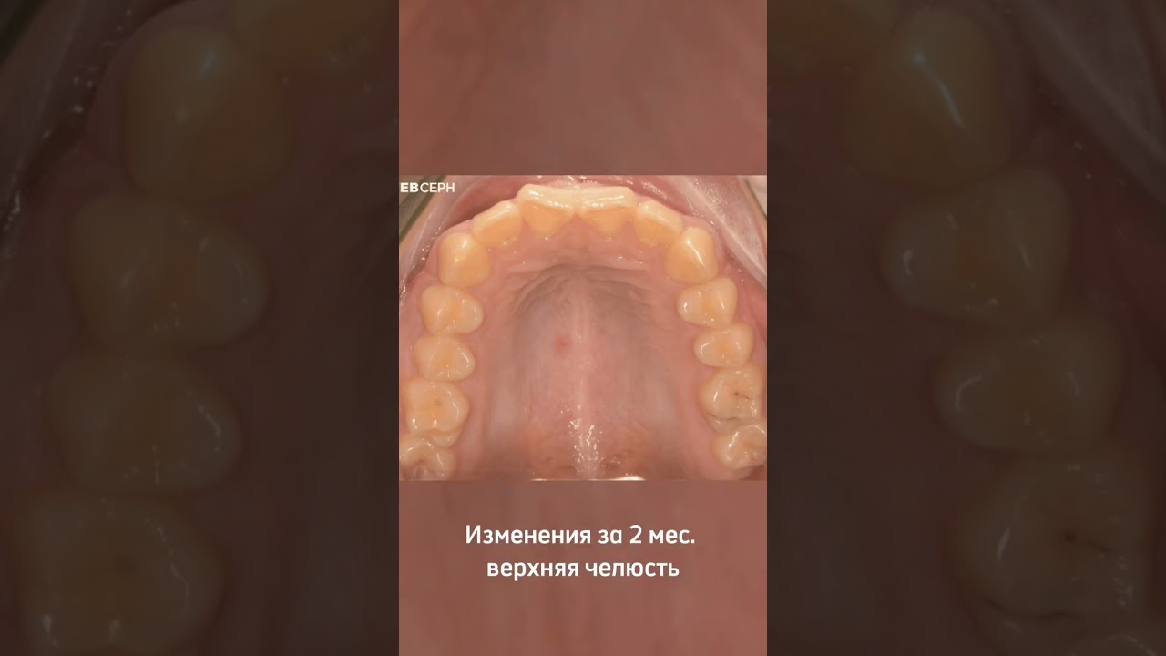 Прошло 2 месяца после установки брекет-системы
