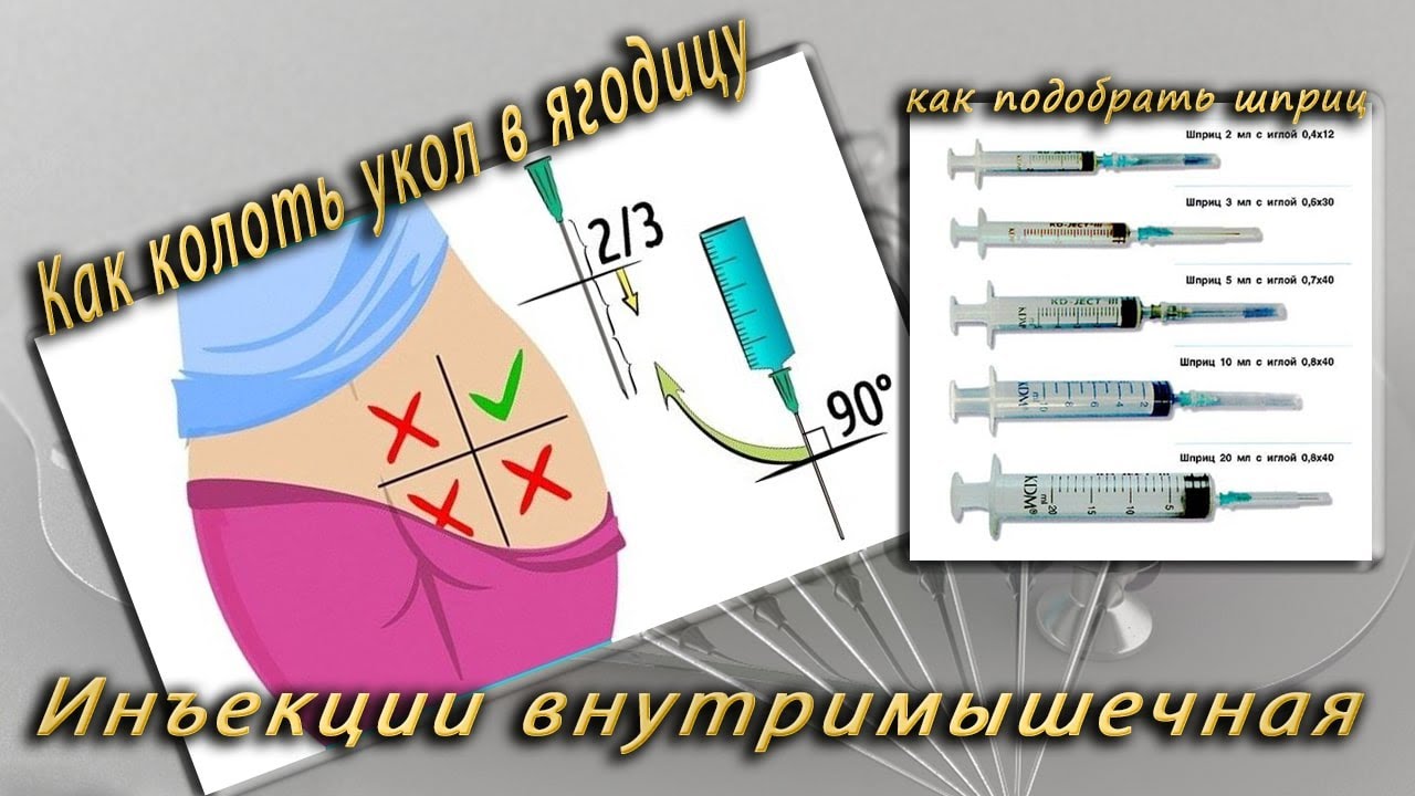 Сколько длится укол. Как правильно делать укол. Как правильно делать укол внутримышечно. Как сделать укол в ягодицу. Как правильно делать УК.