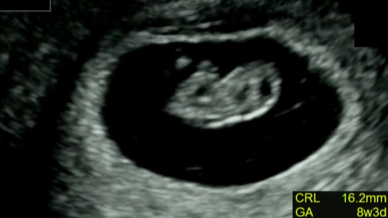 エコー 妊娠8週目 心拍の確認が取れました Youtube
