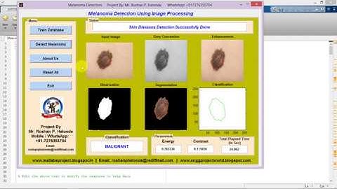 Melanoma / Skin Cancer Detection Using Image Processing Matlab Project with Source Code
