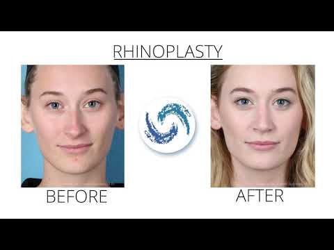 Rhinoplasty | Holcomb Kreithen Plastic Surgery
