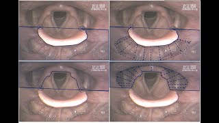 Details VASES Unofficial Scoring Sheet Overview + Review of Anatomic and Temporal Boundaries Update