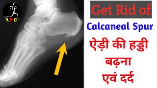 calcaneal spur । heel pain । heel spur । edi ka dard । edi ki haddi badhna screenshot 4