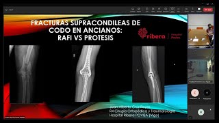9ª Sesión Clínica Interhospitalaria - POVISA - Fx Supracondíleas de Codo en Ancianos (Sin Audio)